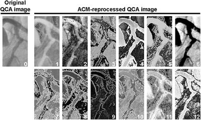 Assessment of New Coronary Features on Quantitative Coronary Angiographic Images With Innovative Unsupervised Artificial Adaptive Systems: A Proof-of-Concept Study